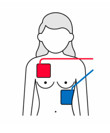 AED pads on Adults