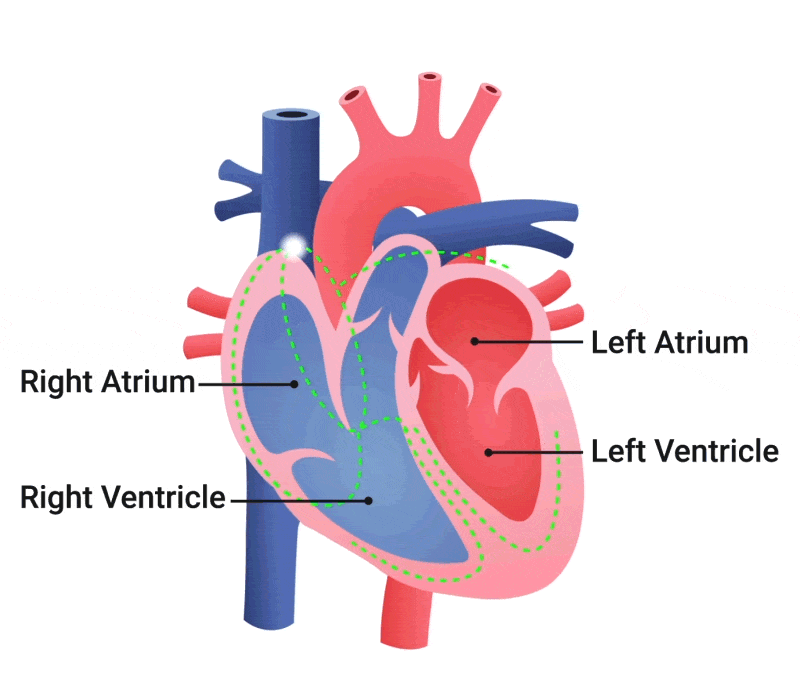 Arrhythmia Mechanism animated