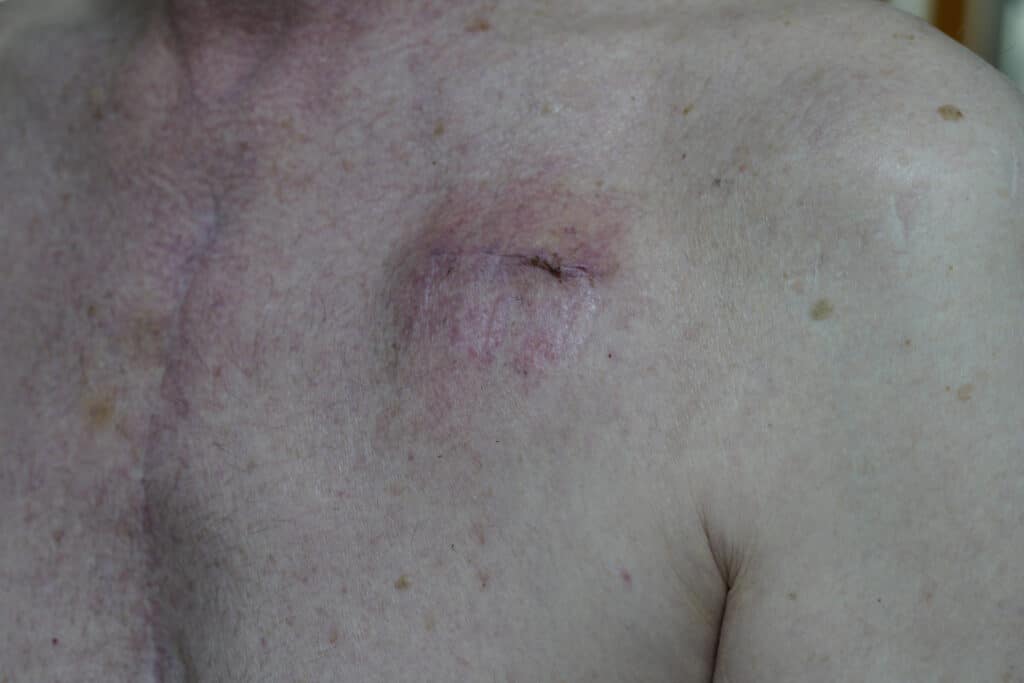 Cardiac Patient with Pacemaker 2 1024x683 1